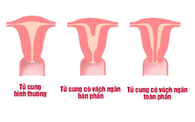 Hình ảnh tử cung có vách ngăn hoàn toàn