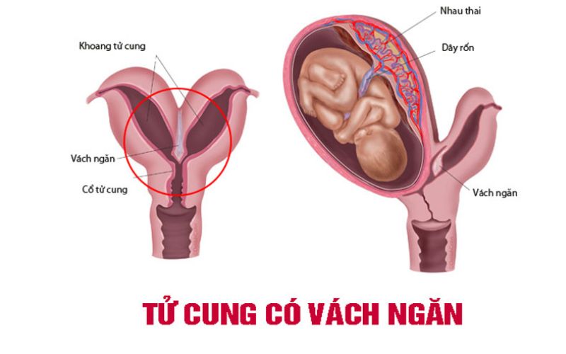 Mô phỏng tử cung có vách ngăn không hoàn toàn