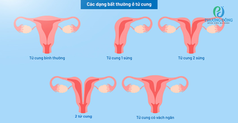 Hình ảnh tử cung đôi trong thực tế