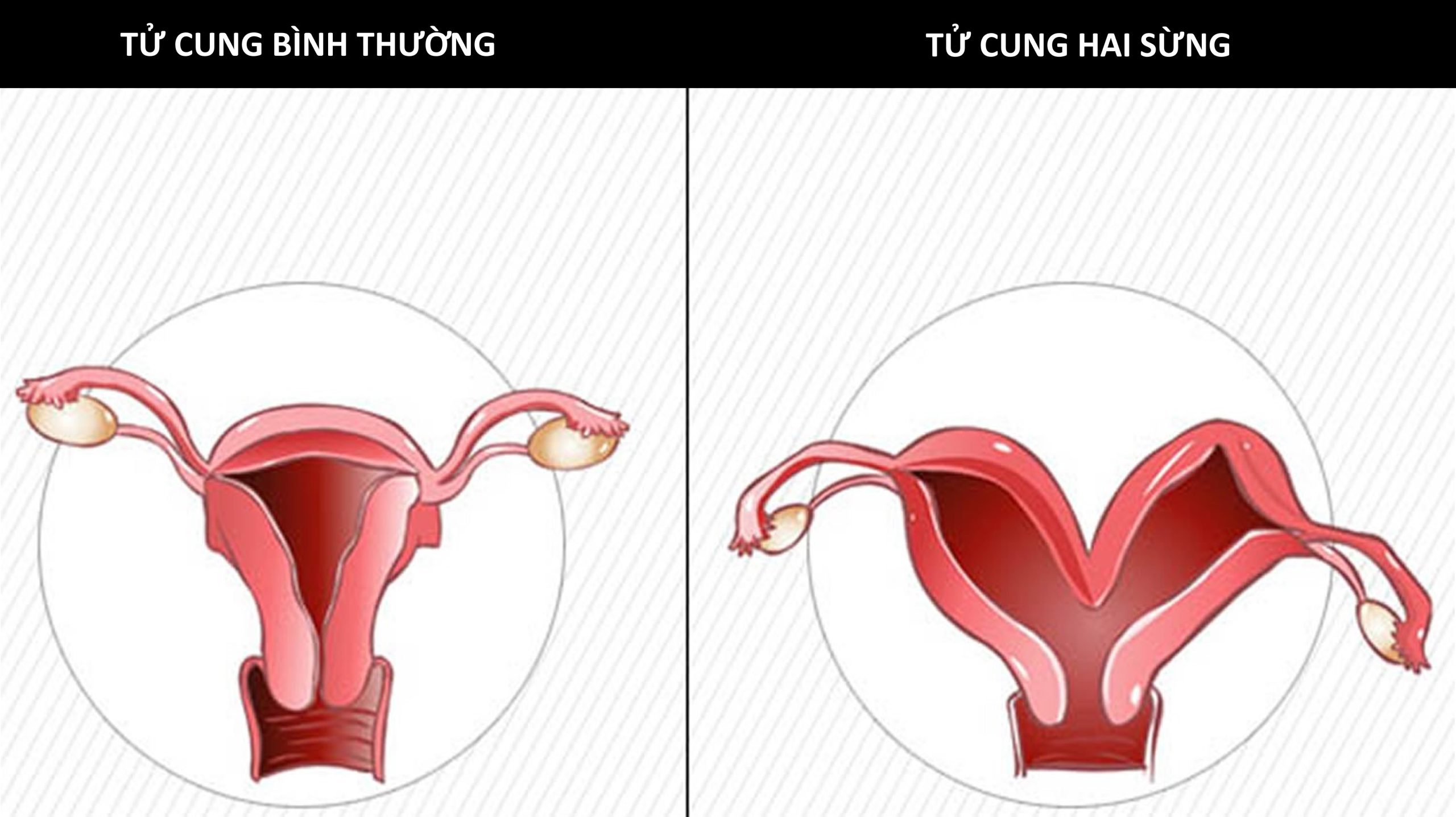 tử cung hai sừng là gì