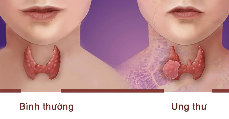Tuyến ức là gì
