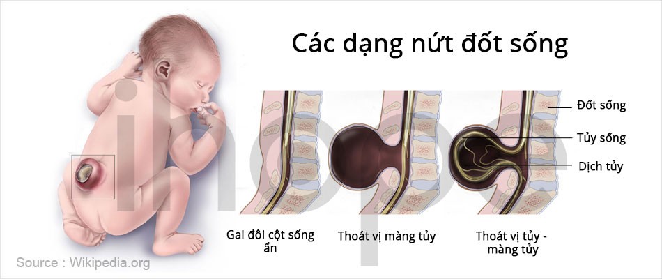 Các dạng tật nứt đốt sống