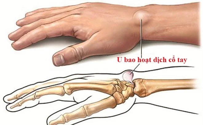 Chẩn đoán viêm bao hoạt dịch ở tay