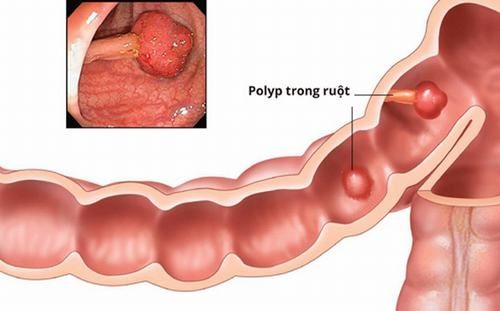Phân biệt u đại tràng lành tính và ác tính