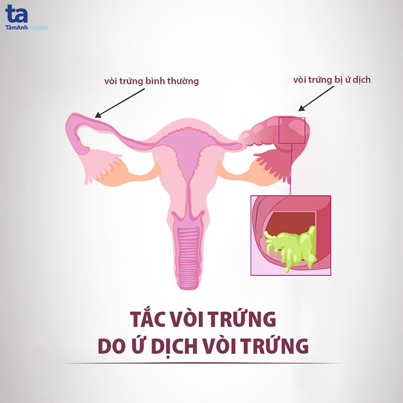 Tắc đoạn xa vòi trứng gây ứ dịch