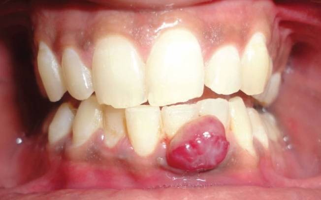 u-hat-sinh-mu-pyogenic-granuloma.jpg