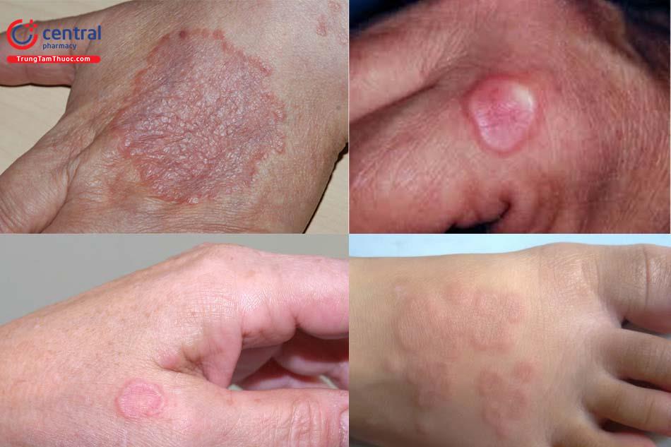 Tổn thương điển hình của u hạt vòng