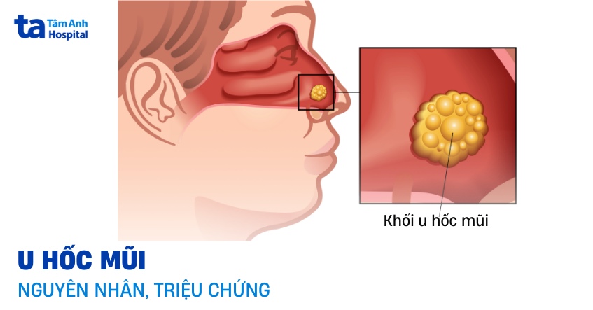 U hốc mũi là gì