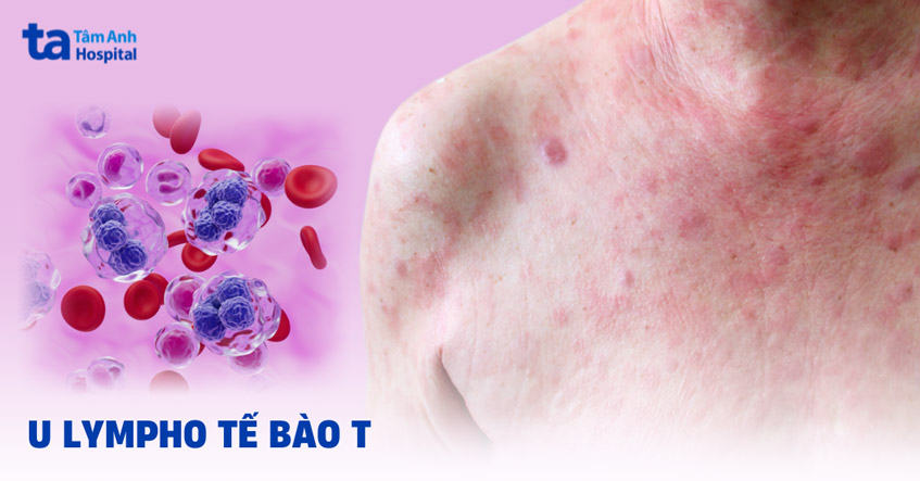 U lympho tế bào T ngoại vi, không đặc hiệu: Triệu chứng, nguyên nhân và hướng điều trị 7 Hình ảnh tế bào lympho T bất thường