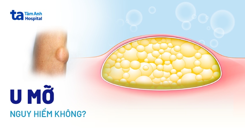 u mỡ dưới da