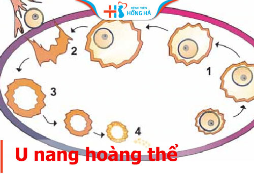 U nang hoàng thể trên siêu âm