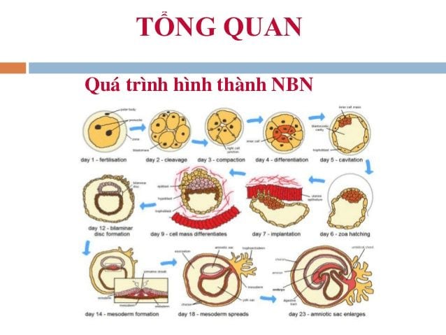 Hình ảnh thực thể u nguyên bào nuôi