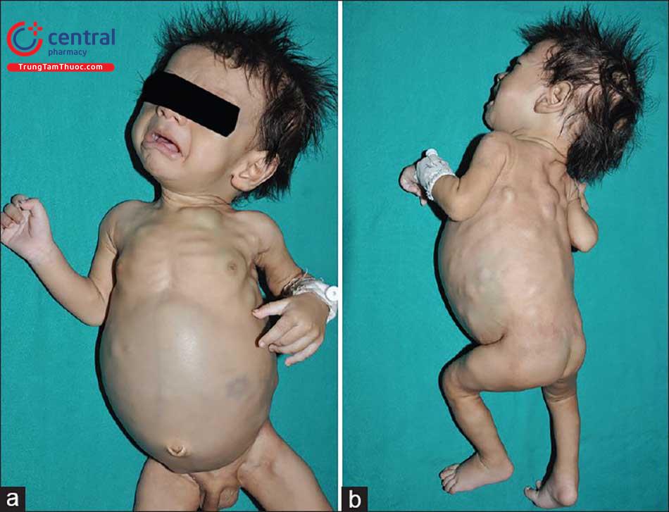U nguyên bào thần kinh (Neuroblastoma): Ung thư nguy hiểm ở trẻ em không thể xem nhẹ 7 U nguyên bào thần kinh ở trẻ em