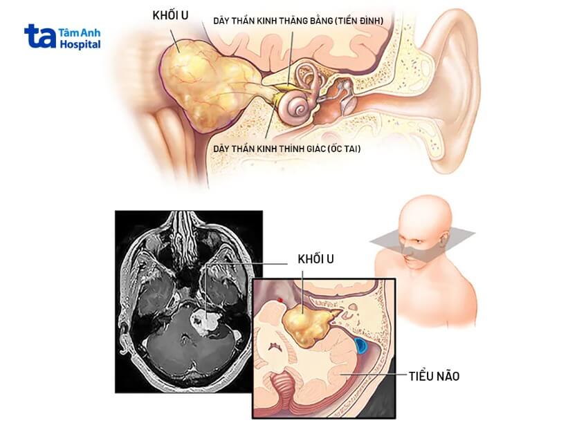 Ảnh MRI khối u Schwannoma
