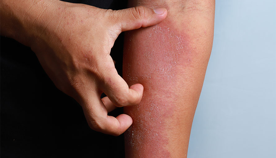 Các giai đoạn tổn thương da của Mycosis Fungoides