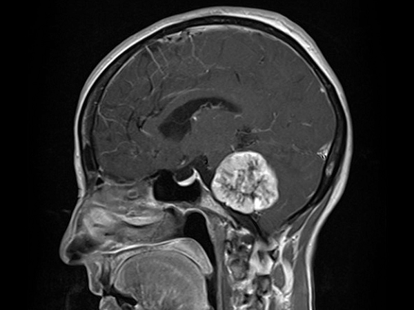 Hình ảnh mô phỏng Schwannoma trên MRI