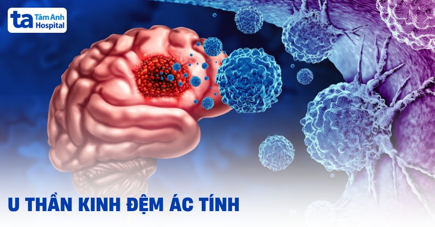 Hình ảnh u thần kinh đệm ác tính qua MRI