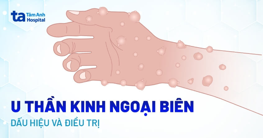 U Bao Dây Thần Kinh Ngoại Biên Ác Tính: Những Thông Tin Bệnh Nhân Cần Biết 7 Hình ảnh minh họa u thần kinh ngoại biên ác tính