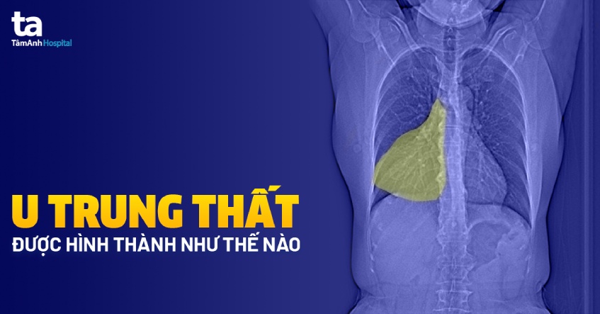 Hình ảnh minh họa về vị trí u trung thất