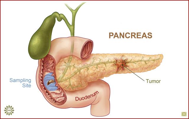 Ảnh chụp MRI u tuỵ nội tiết insulinoma