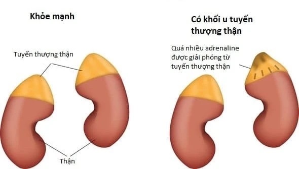 U tủy thượng thận