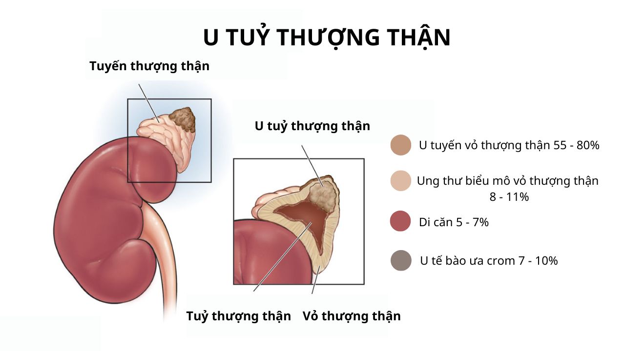 Triệu chứng u tủy thượng thận