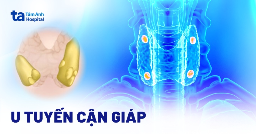 Hình ảnh tuyến cận giáp trên siêu âm