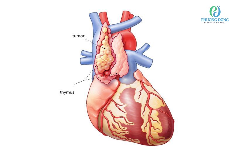 Hình ảnh u tuyến ức trên phim chụp