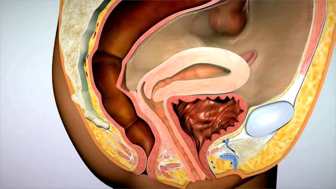 Adenomyosis trong cơ tử cung