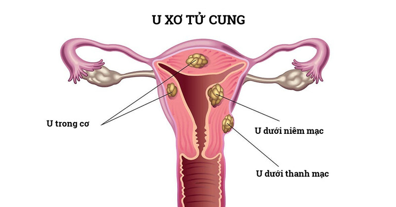 U xơ tử cung dưới niêm mạc hình ảnh nội soi