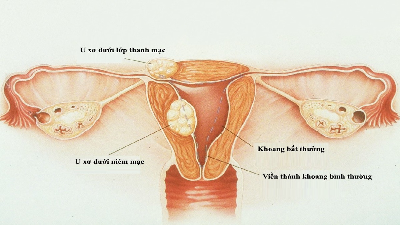 Hình ảnh minh họa u xơ tử cung dưới niêm mạc
