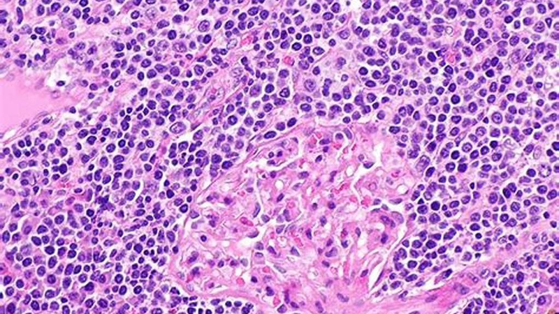 Hình ảnh minh họa tế bào lympho B trong DLBCL