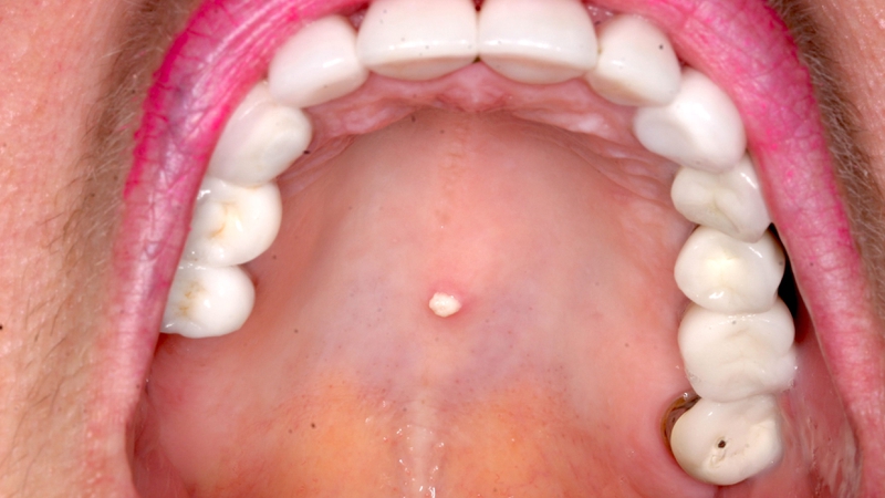 Hình ảnh mô học papilloma vảy