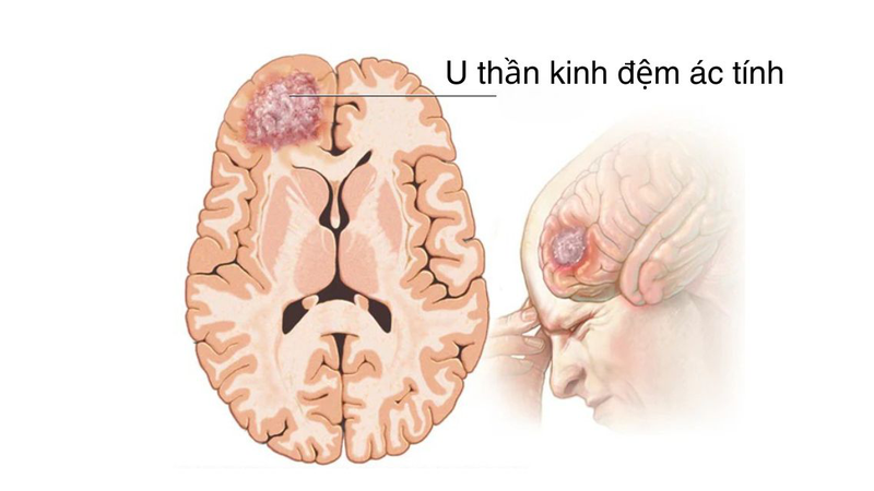 Chẩn đoán hình ảnh glioblastoma qua MRI
