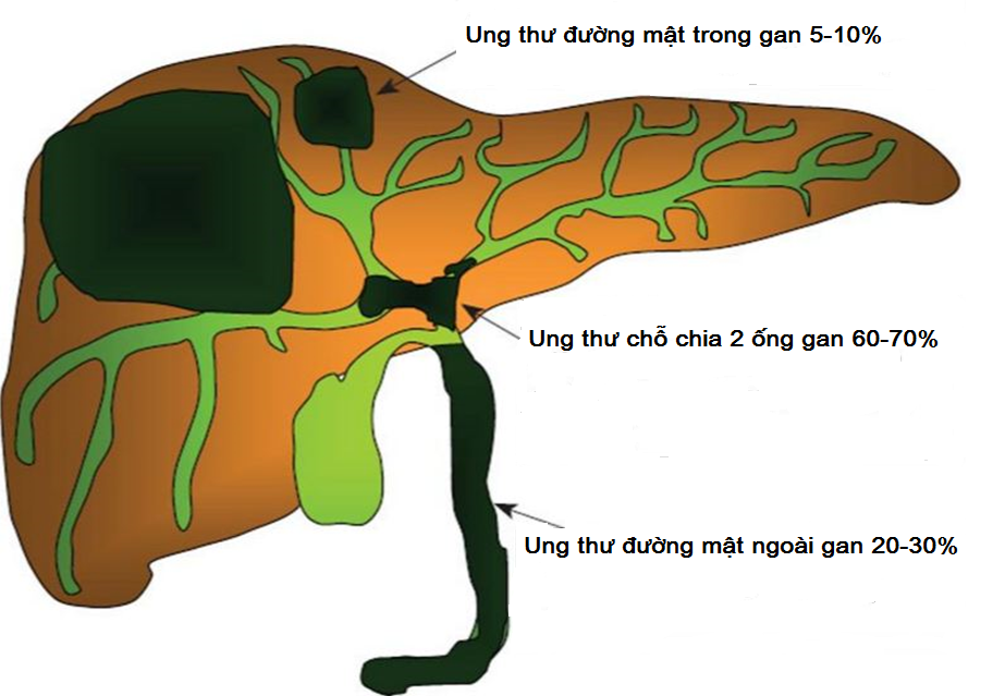 hình ảnh ung thư đường mật