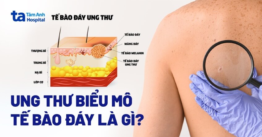 Ung thư biểu mô tế bào đáy