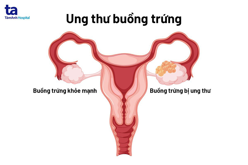 Ung thư buồng trứng là gì?