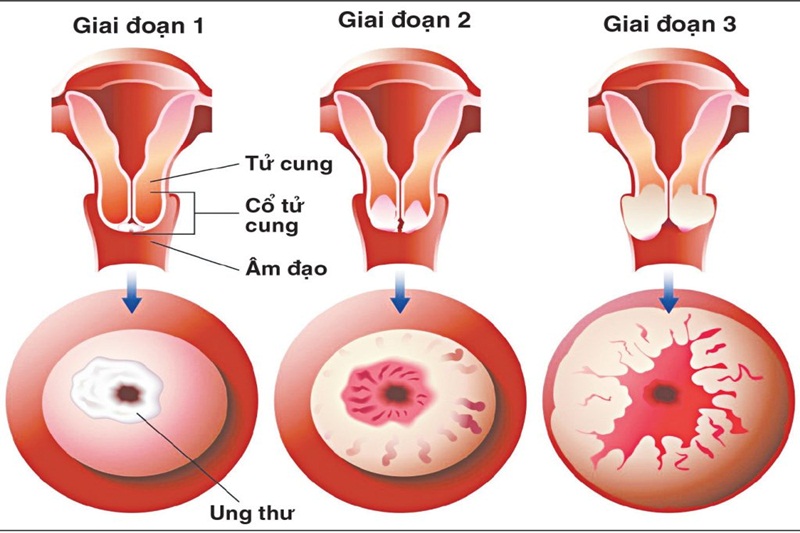 Hình ảnh khối u cổ tử cung