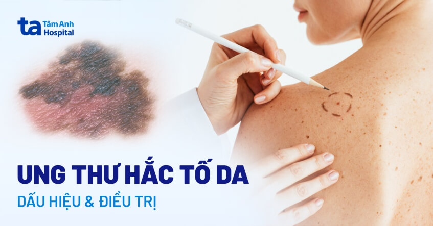 Hình ảnh ung thư hắc tố da
