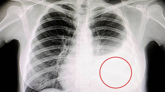Ung thư biểu mô di căn đến màng phổi: Triệu chứng, chẩn đoán và hướng điều trị 8 Chẩn đoán ung thư màng phổi