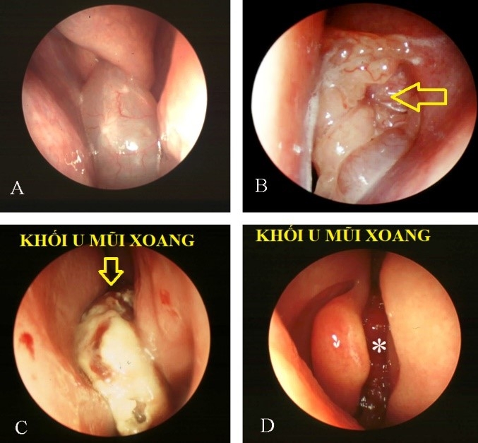Triệu chứng ung thư mũi