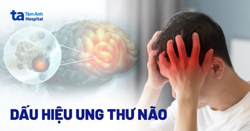 Hình ảnh chụp u não