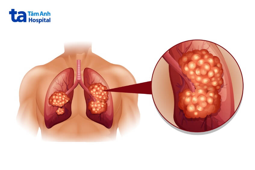 Ung thư biểu mô di căn đến màng phổi: Triệu chứng, chẩn đoán và hướng điều trị 7 Ung thư phổi di căn đến màng phổi