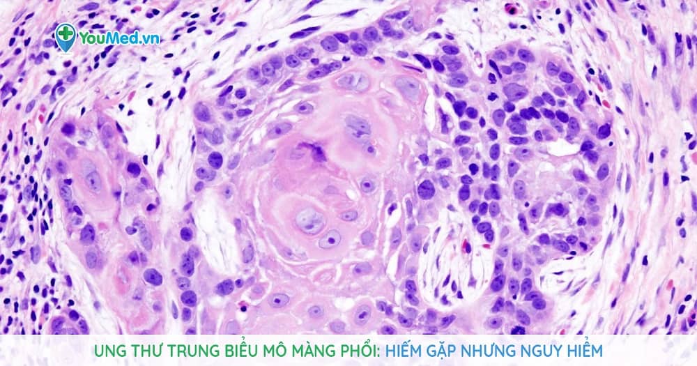 Hình ảnh u trung biểu mô màng phổi