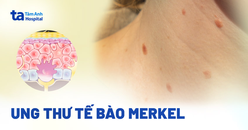 Hình ảnh ung thư tế bào Merkel