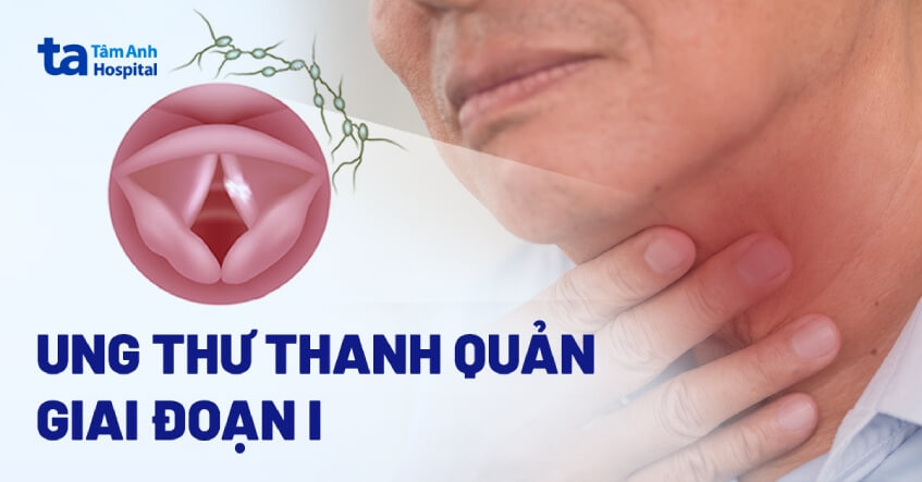 Hình ảnh ung thư thanh quản giai đoạn sớm