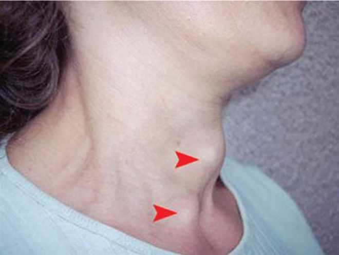 Ung thư tuyến giáp không biệt hóa là gì? 7 Hình ảnh ung thư tuyến giáp không biệt hóa