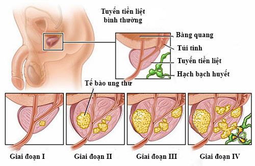 Triệu chứng ung thư tuyến tiền liệt