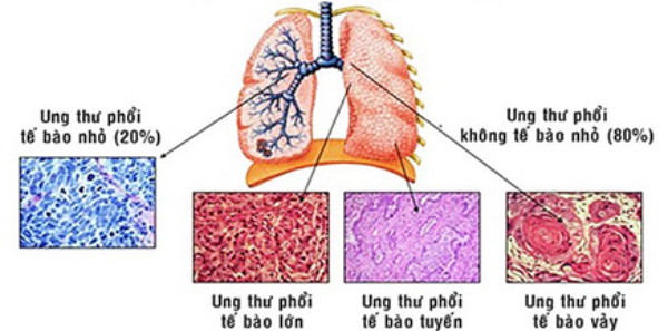Ung thư biểu mô tuyến của phổi