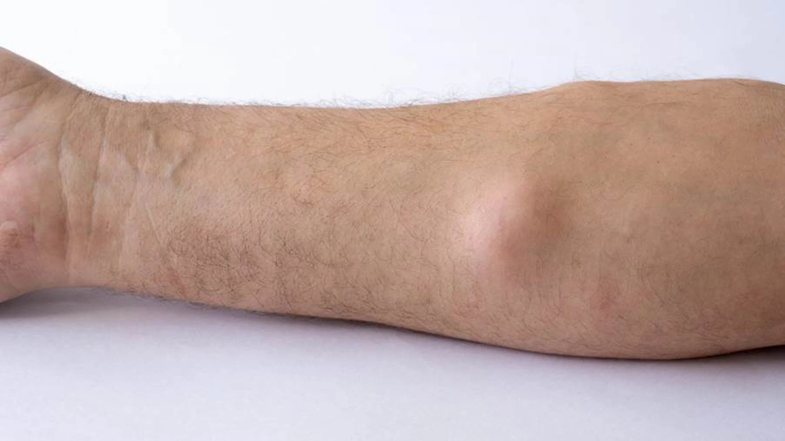 Hình ảnh sarcoma cơ vân ở trẻ